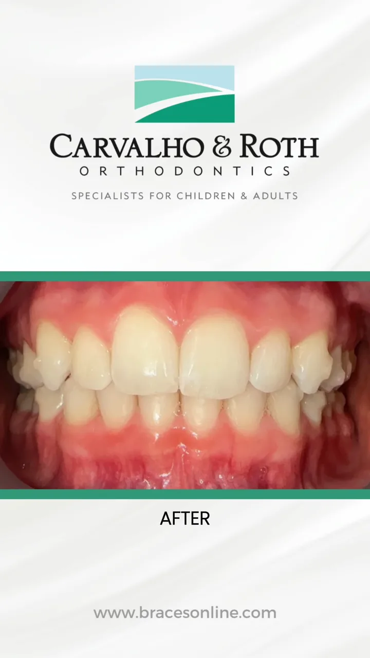After view from the practice’s smile alignment comparison video