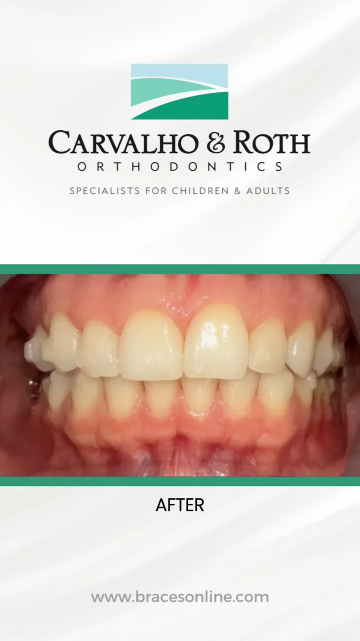After view from the practice’s front teeth before and after video