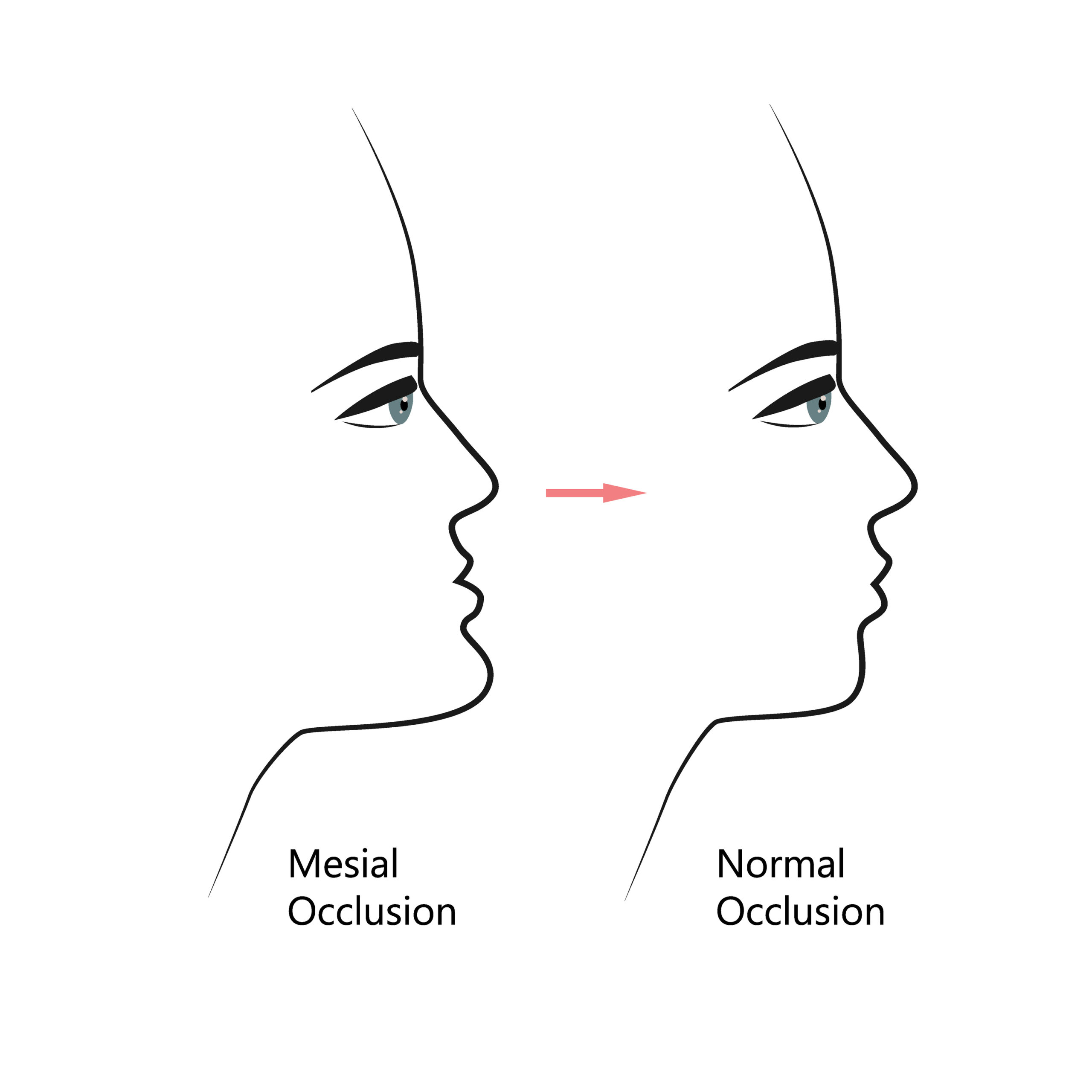 Side view showing how braces may help correct an underbite